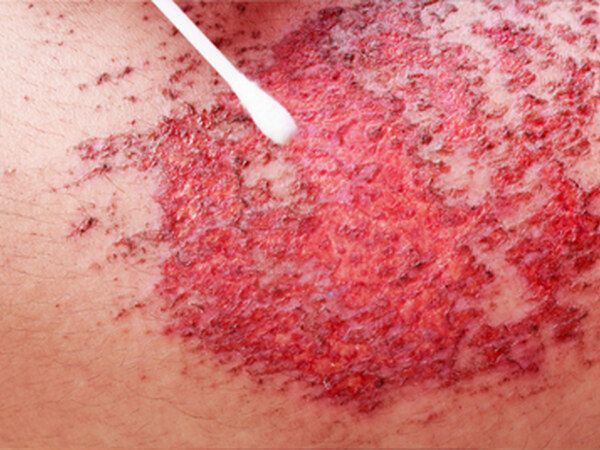 Abrasion / Traumatic Wounds treated by Dr. Rizvi Wound Care