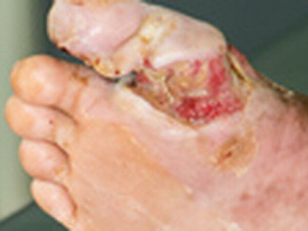 Diabetic Foot Ulcers & Complications treated by Dr. Rizvi Wound Care