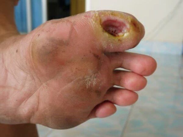Diabetic Ulcers / Wound Infections treated by Dr. Rizvi Wound Care