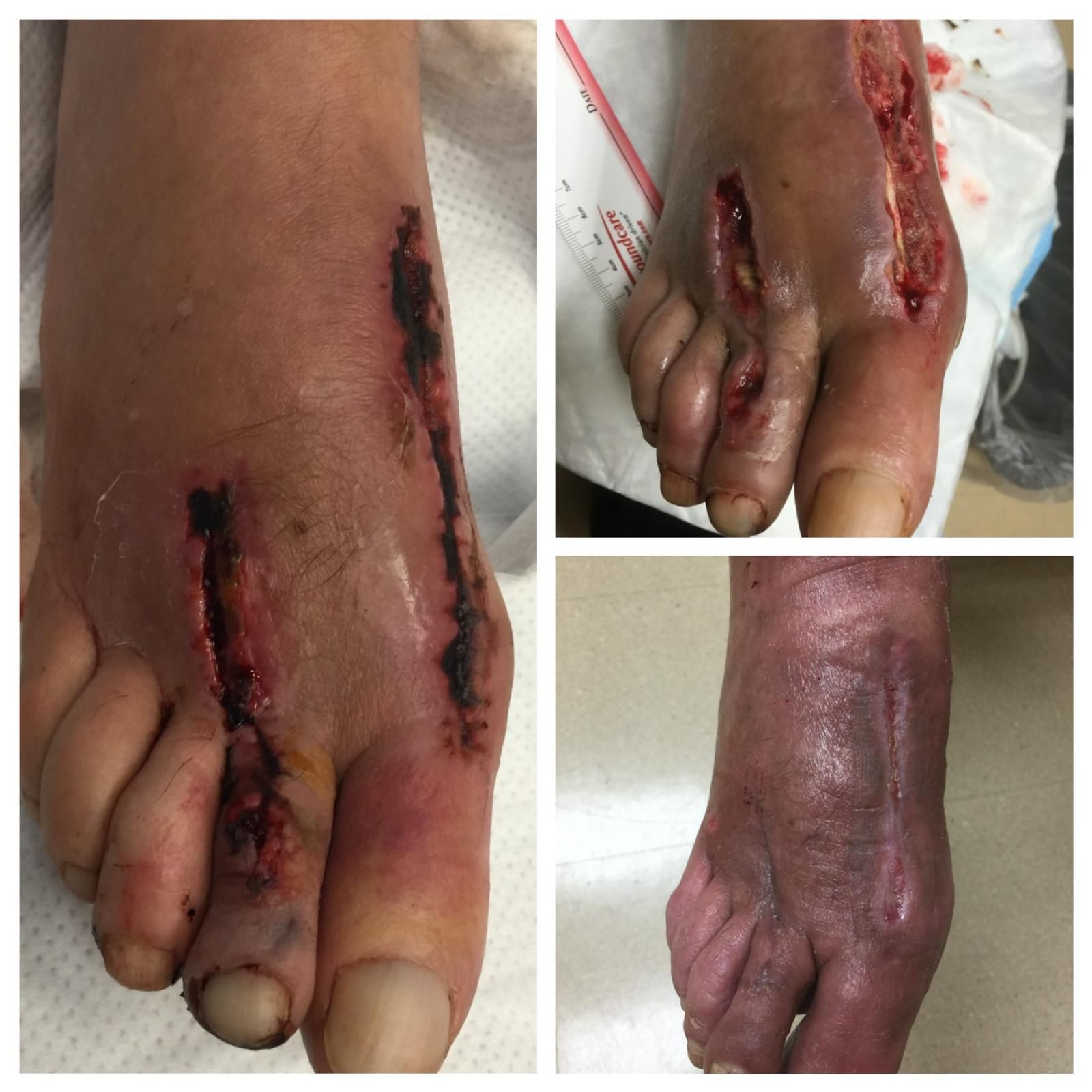 Before-and-after photos of a post-surgical non-healing foot wound healed at Dr. Rizvi Wound Care