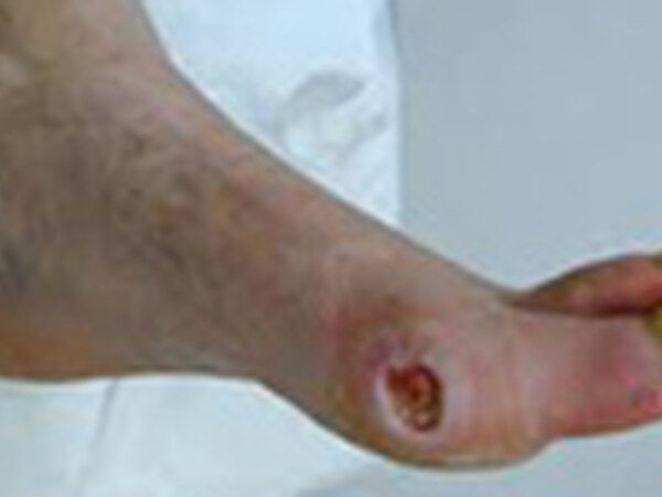 Arterial Wound / Gangrene treated by Dr. Rizvi Wound Care