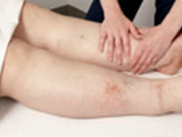 Lymphedema / Limb Swelling treated by Dr. Rizvi Wound Care