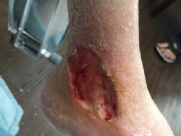 Osteomyelitis / Bone Infections treated by Dr. Rizvi Wound Care