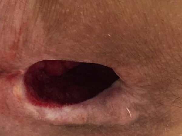 Pressure Ulcers / Bed Sores treated by Dr. Rizvi Wound Care
