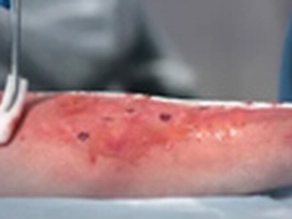 Skin Burns / Wounds treated by Dr. Rizvi Wound Care