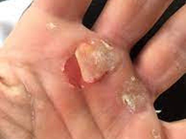 Skin Tears / Traumatic Wounds treated by Dr. Rizvi Wound Care