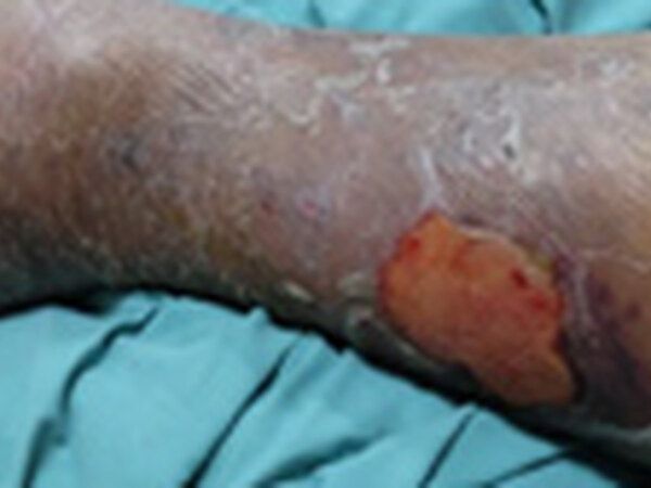 Venous Ulcers treated by Dr. Rizvi Wound Care