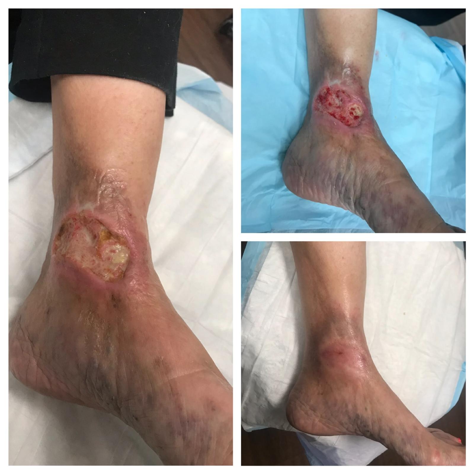 Before-and-after photos of a chronic non-healing left ankle wound healed at Dr. Rizvi Wound Care