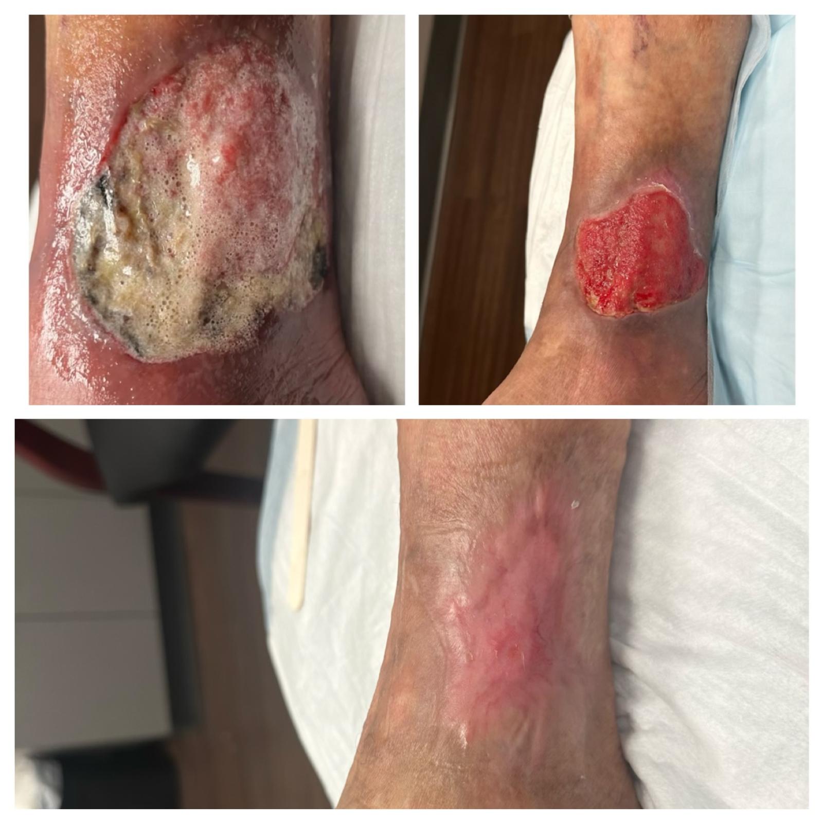 Before-and-after photos of a complex non-healing chronic venous insufficiency ulcer on the leg of an elderly patient healed at Dr. Rizvi Wound Care