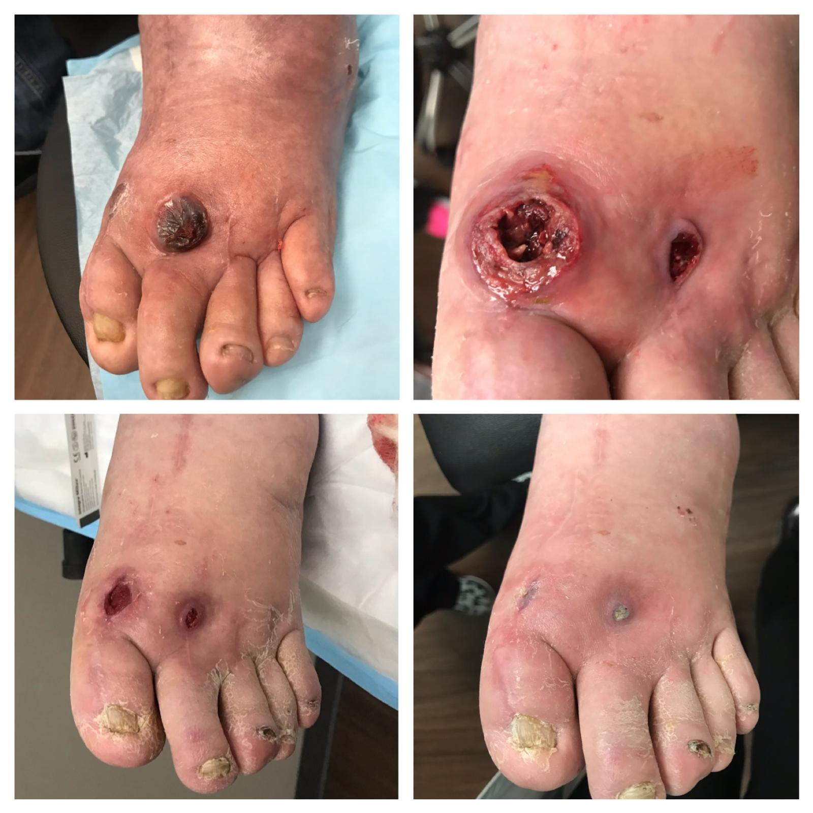 Before-and-after photos of traumatic hematomas on the foot healed at Dr. Rizvi Wound Care