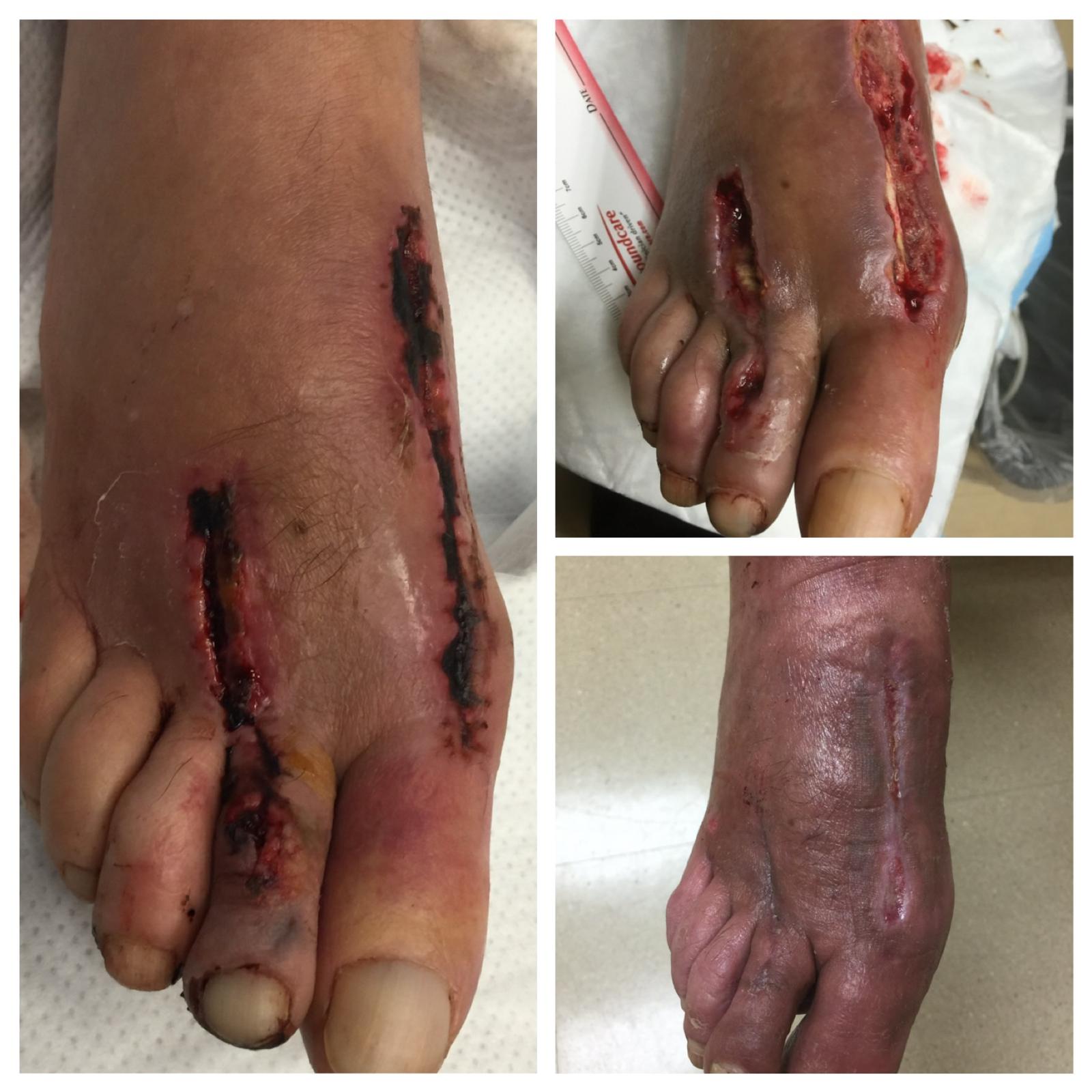 Before-and-after photos of a post-surgical non-healing foot wound healed at Dr. Rizvi Wound Care