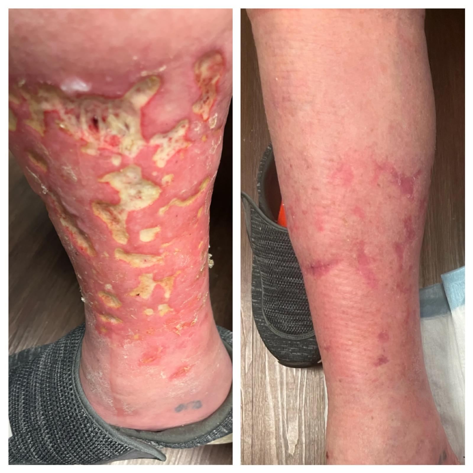 Before-and-after photos of a chronic non-healing lower-leg wound with infection healed at Dr. Rizvi Wound Care