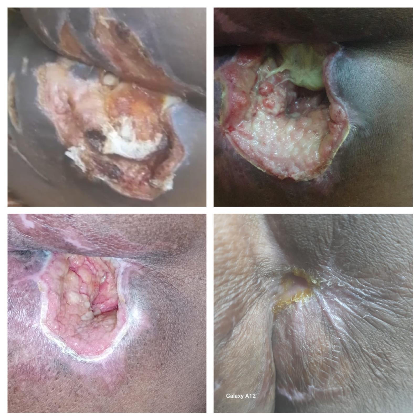 Before-and-after photos of a chronic non-healing sacral pressure wound on an elderly patient treated by Dr. Rizvi Wound Care