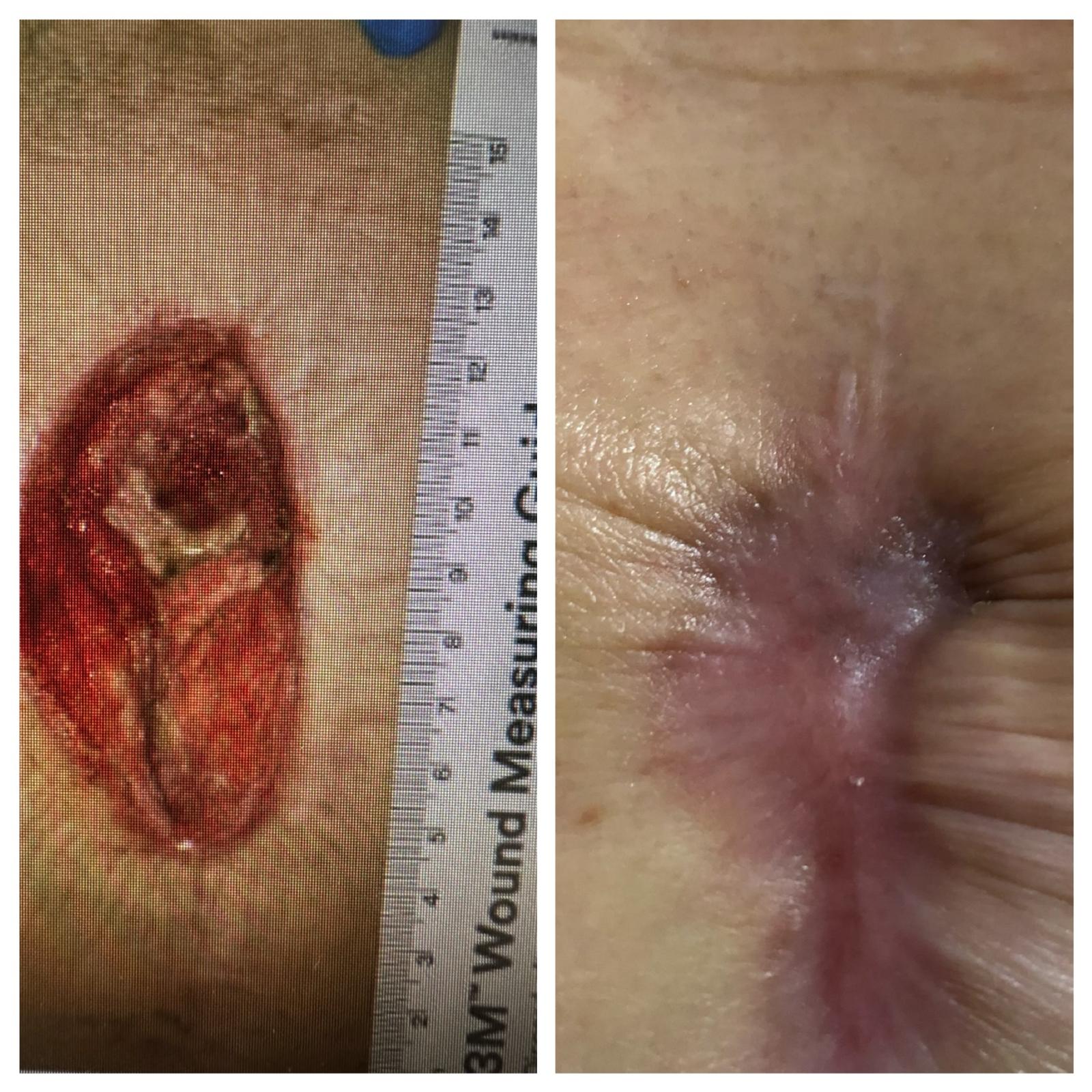 Before-and-after photos of a sternal wound after open-heart surgery healed at Dr. Rizvi Wound Care