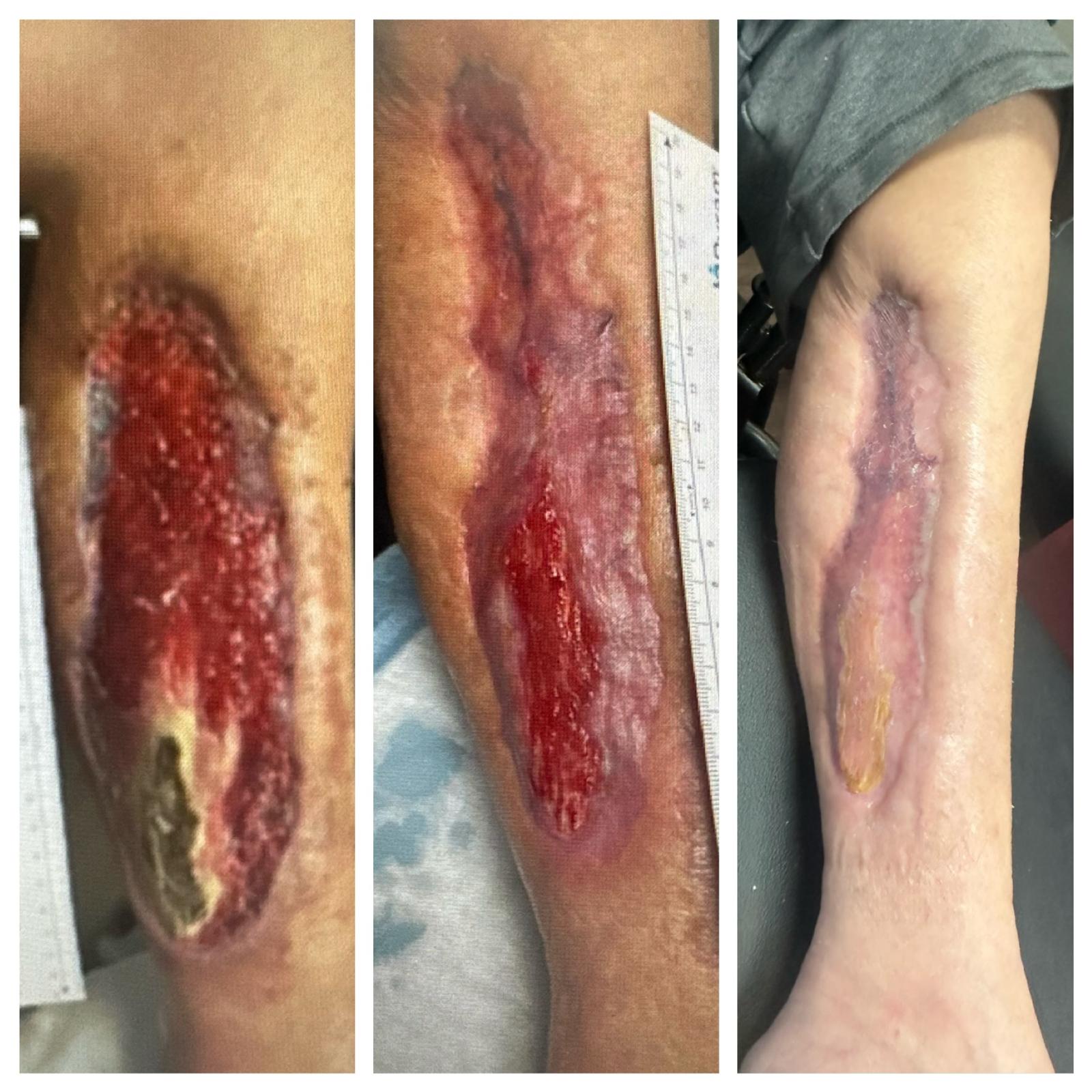 Before-and-after photos of a chronic non-healing leg wound with tendon exposure healed at Dr. Rizvi Wound Care