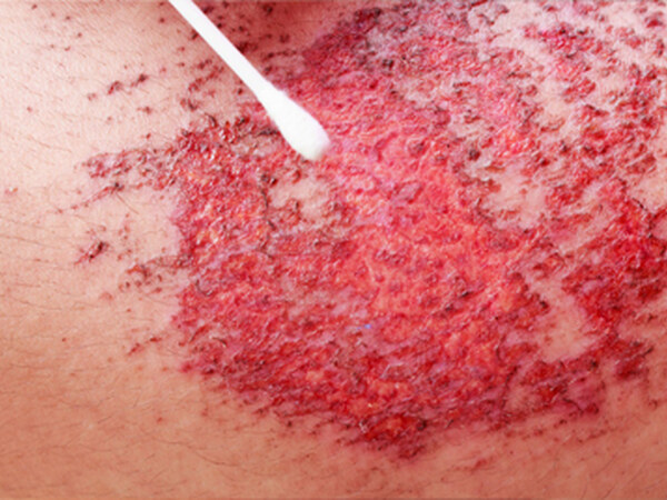 Abrasion / Traumatic Wounds treated by Dr. Rizvi Wound Care