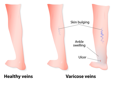 VENOUS ULCERS | Dr. Rizvi Primary Care and Wound Care Center pregnant woman stomach diagram 
